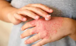 Egzamaya Faydalı Sanılan Ürün Aslında Zararlıymış: Cilt Kuruyor