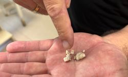 Sağlıkta İlginç Vaka: Tükürük Bezinden 5 Taş Çıktı