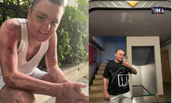 Kağıthane’de Kuaförde Yanan 14 Yaşındaki Engin’in Tedavisi Tamamlandı