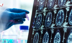 Alzheimer’da Gizli Evre Deşifre Oldu: Belirtiler Çıkmadan Yıllar Önce Başlıyor