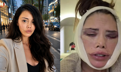 Survivor Didem Ceran'ın Kabus Dolu Estetik Serüveni