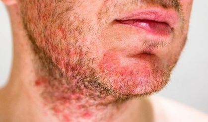 Egzama Hastalarına Kritik Uyarı: Stres Ciltteki İltihabı Körüklüyor