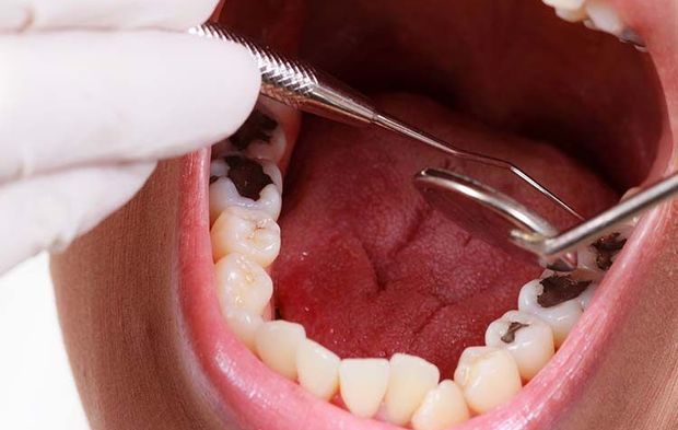 Erken Yaşta Oluşan Çürükler Kalp Sağlığını Etkileyebilir