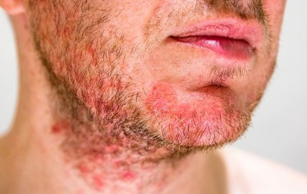 Egzama Hastalarına Kritik Uyarı: Stres Ciltteki İltihabı Körüklüyor