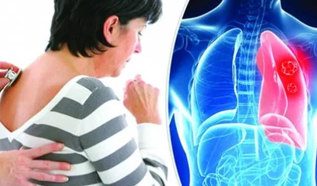 Kadınlarda akciğer kanseri vakalarında artış yaşanıyor