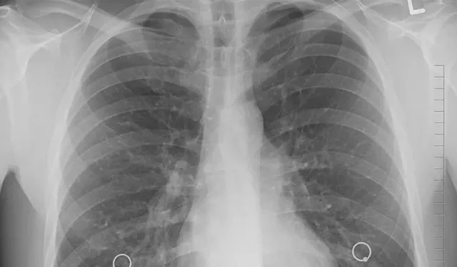 Gizli Tehlike: Sigara İçmeyenlerde Akciğer Kanseri Neden Artıyor