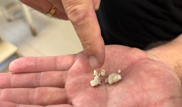 Sağlıkta İlginç Vaka: Tükürük Bezinden 5 Taş Çıktı