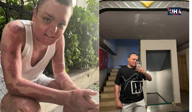 Kağıthane’de Kuaförde Yanan 14 Yaşındaki Engin’in Tedavisi Tamamlandı