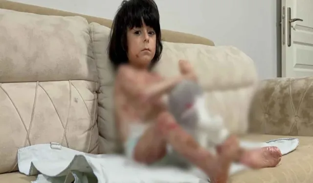 İbrahim ‘Kelebek Hastalığı’ Nedeniyle Kıyafet Giyemiyor