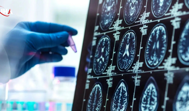 Alzheimer’da Gizli Evre Deşifre Oldu: Belirtiler Çıkmadan Yıllar Önce Başlıyor