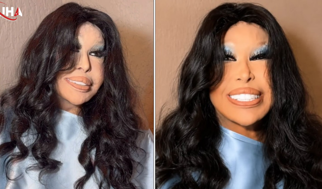 Bülent Ersoy'un Estetik Operasyon Sonrası Sahne Heyecanı