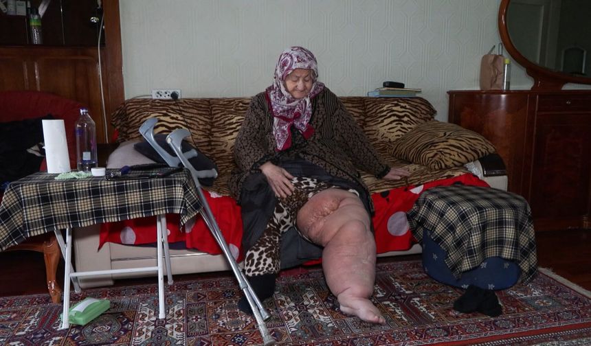 Fil Hastalığıyla Mücadele Eden Vatandaş, Evini Kaybedeceğini Öğrendi ‘Bacağım Bu Haldeyken Nereye Gideceğim’