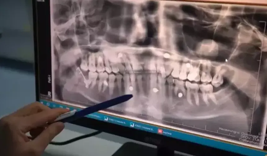 Batman’da kaza geçiren vatandaşın çene kırığı ameliyatla tedavi edildi