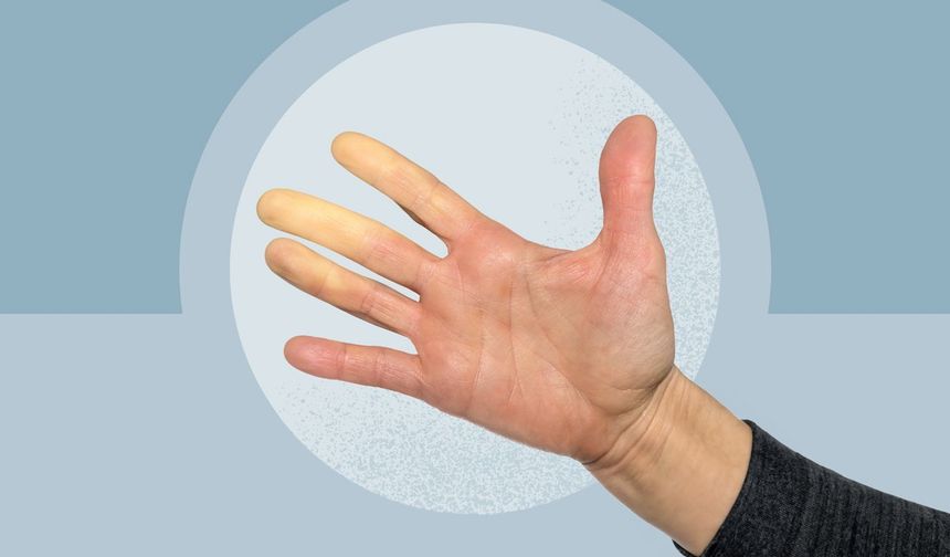 Soğukta Parmaklar Morarıyorsa Dikkat: Raynaud Hastalığı Belirtisi Olabilir