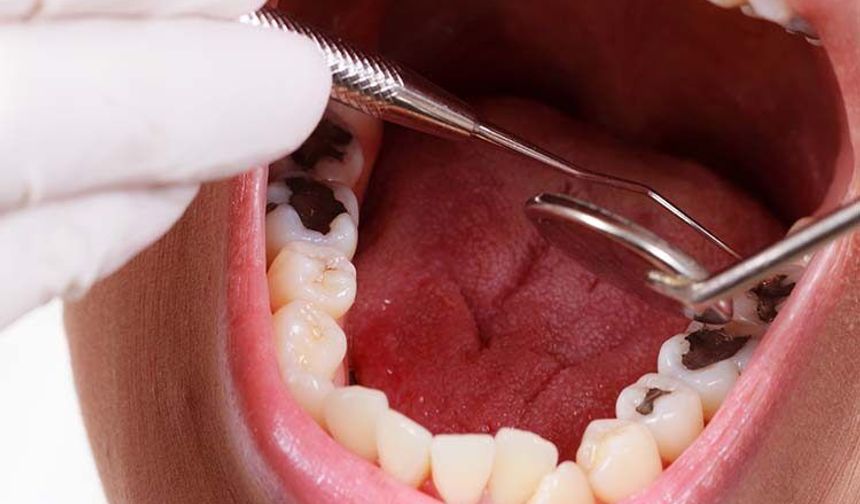 Erken Yaşta Oluşan Çürükler Kalp Sağlığını Etkileyebilir