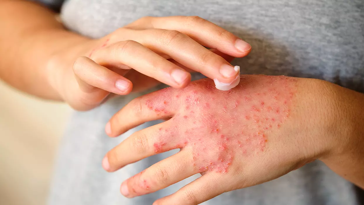 Egzamaya Faydalı Sanılan Ürün Aslında Zararlıymış: Cilt Kuruyor