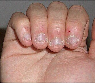 Nailbitebad